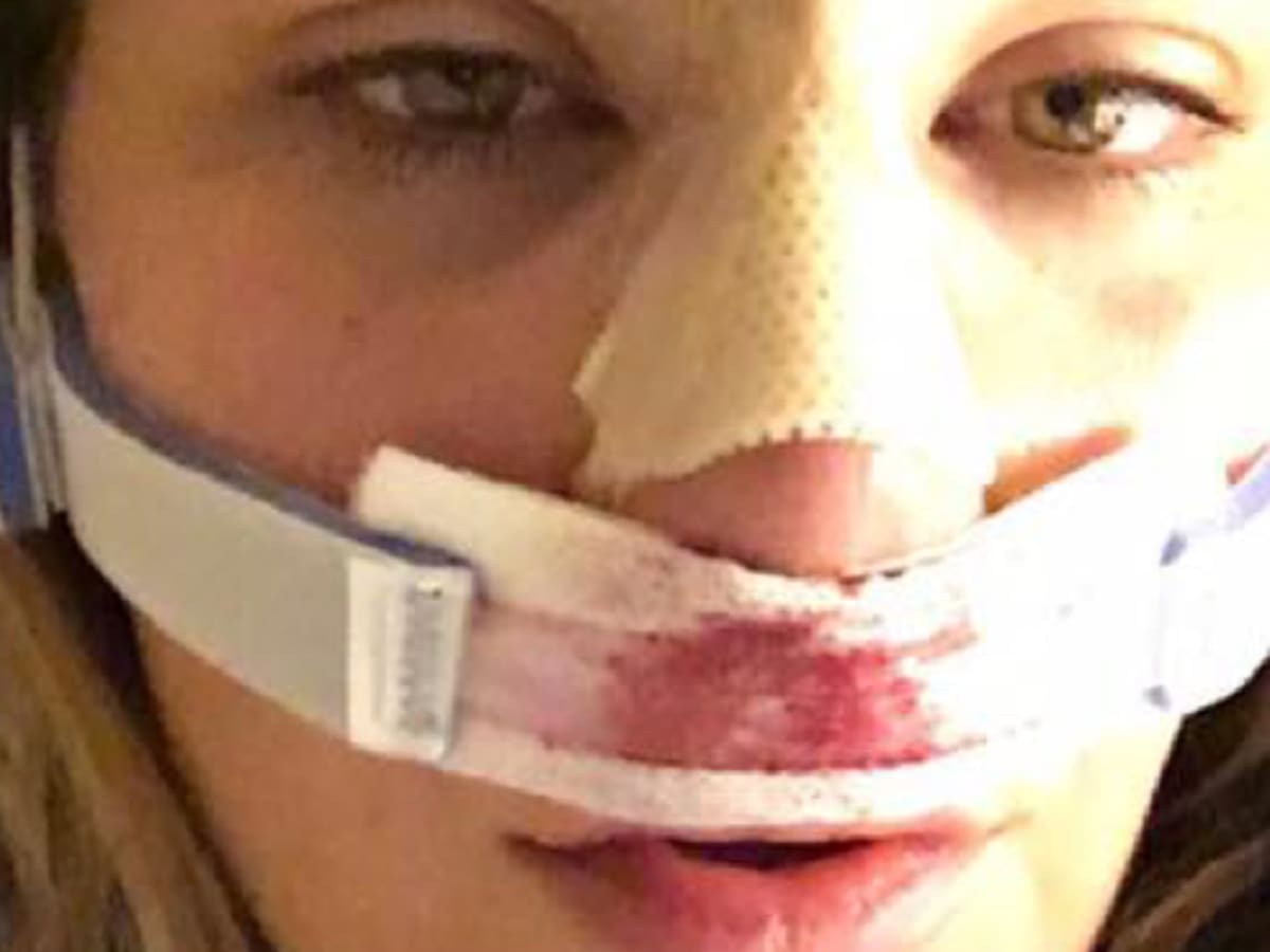 miesha tate broken nose